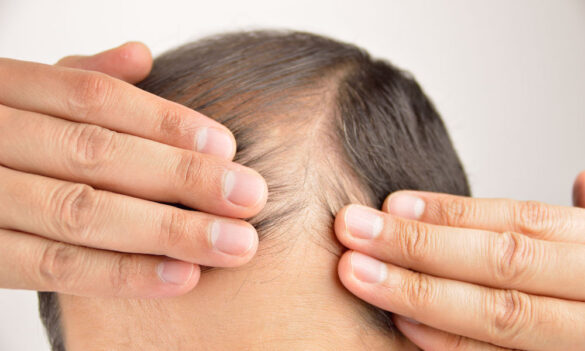 Men’s Hair Loss