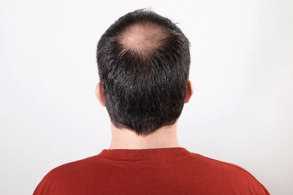 Men’s Hair Loss