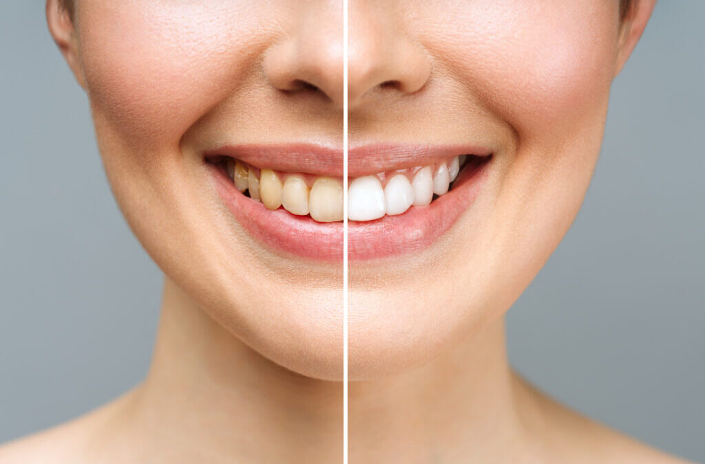 The Benefits of Professional Teeth Whitening Over DIY Kits