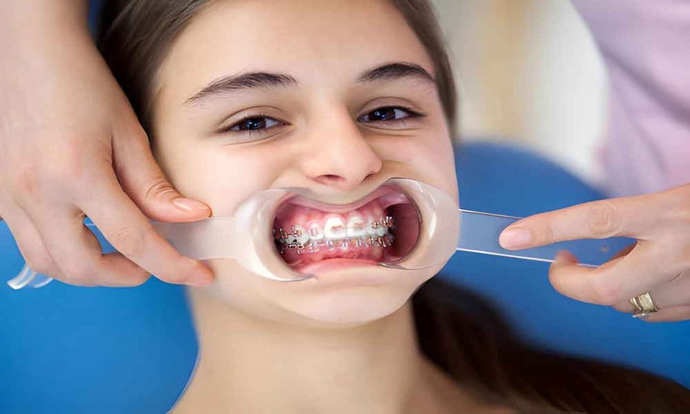 Guide for Parents – Is Your Teen Ready for Braces?