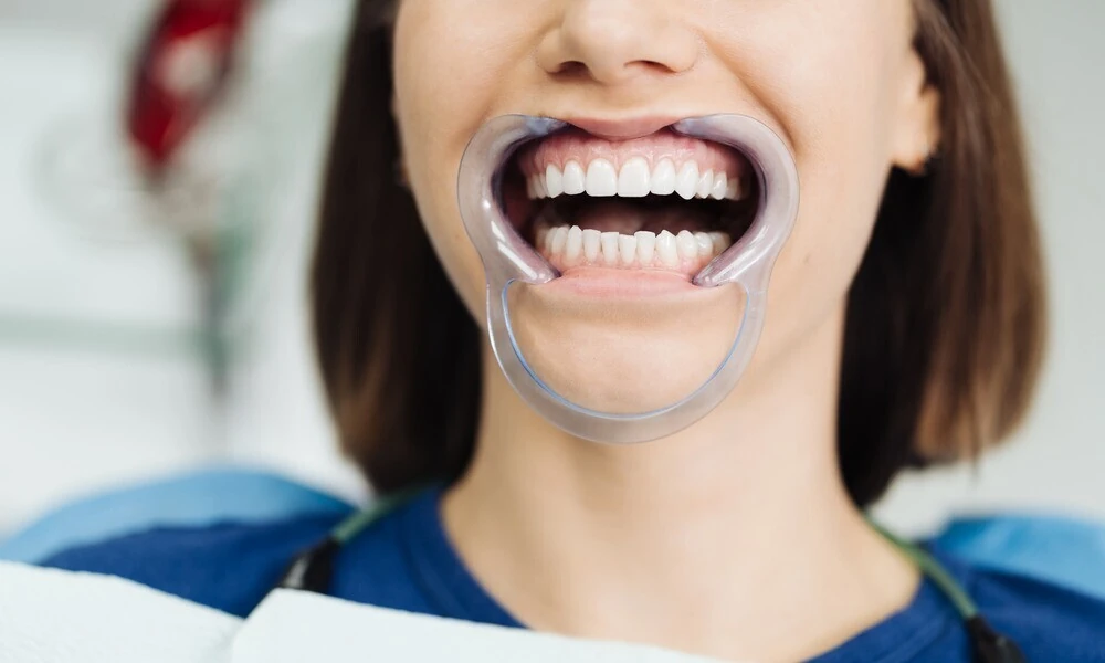 Dental Fillings vs. Crowns vs. Veneers: Choosing the Right Treatment for Your Teeth